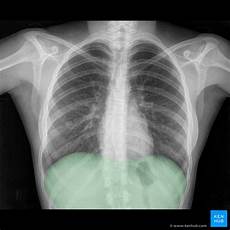 Diaphragm Expansion