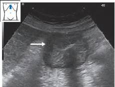 Diaphragm Expansion