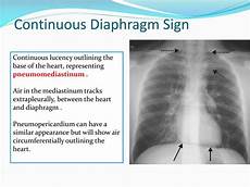 Diaphragm Expansion